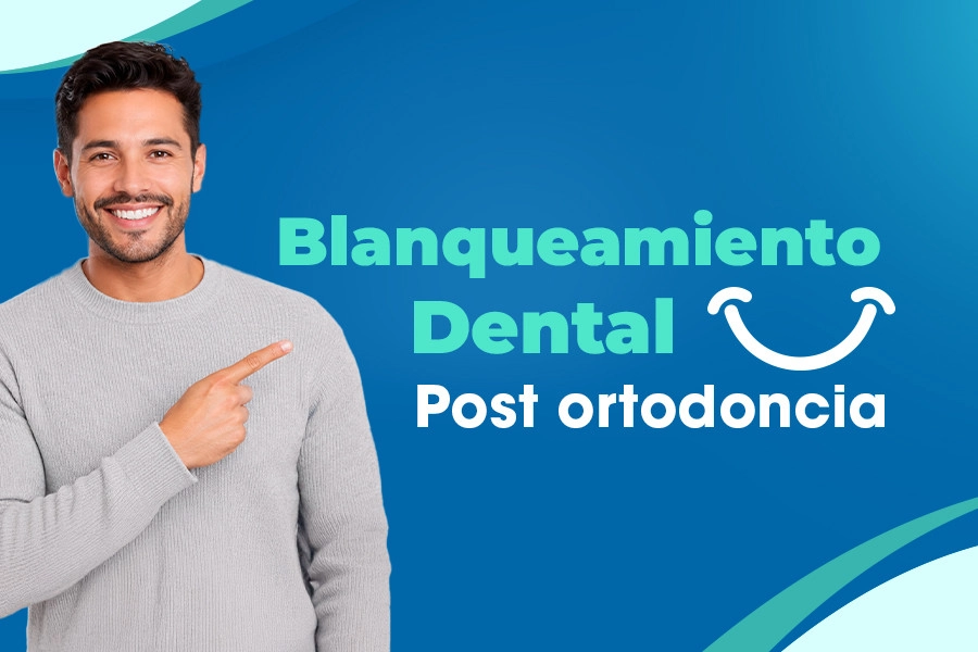 Recent post Blanqueamiento dental post-ortodoncia