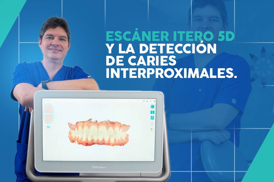 blog Escáner iTero 5D y la detección de caries Interproximales