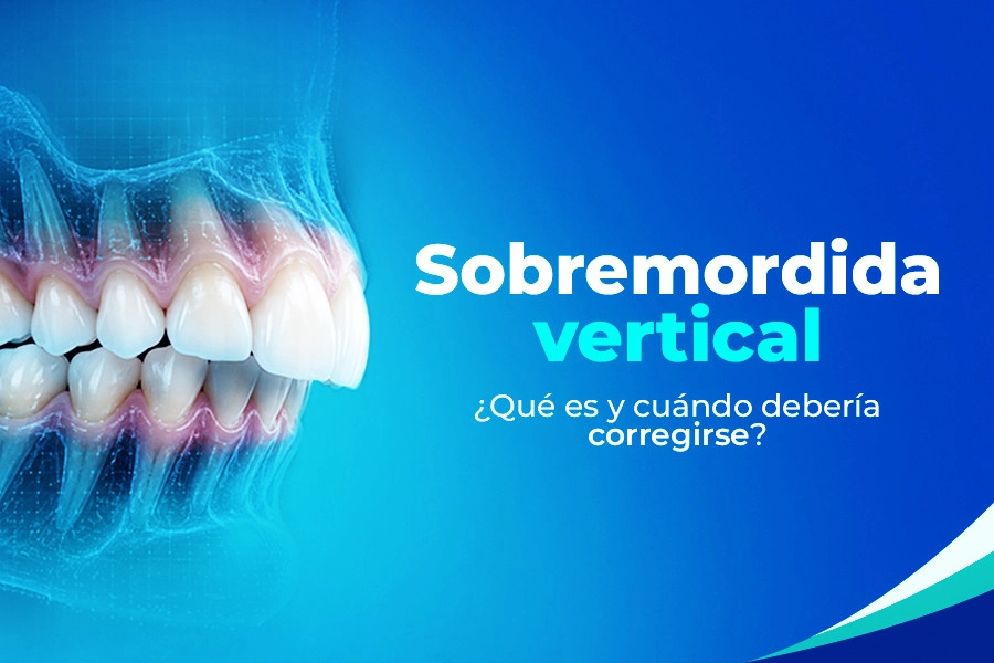 Recent post Sobremordida Vertical ¿Qué es y cuándo debería corregirse?